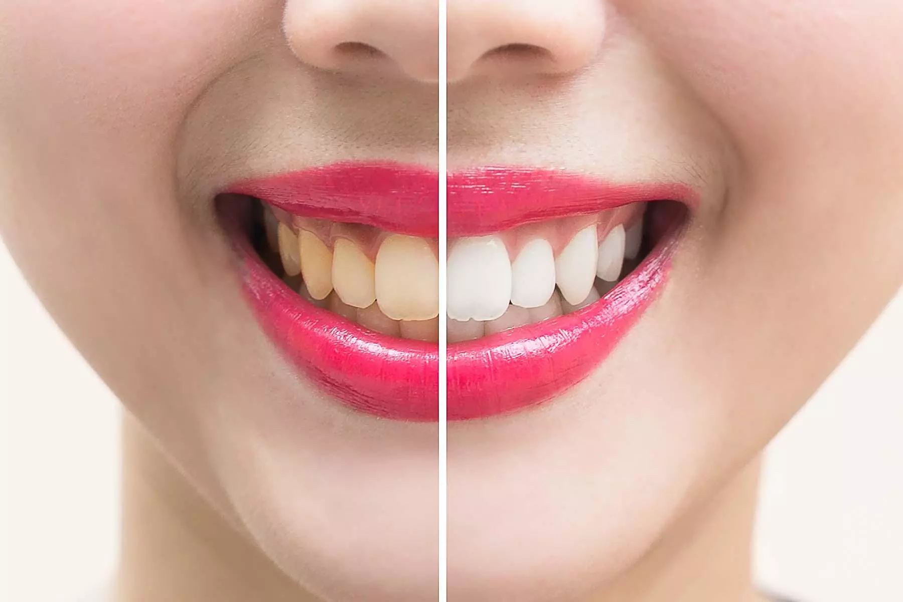 Tooth Whitening in Bristol