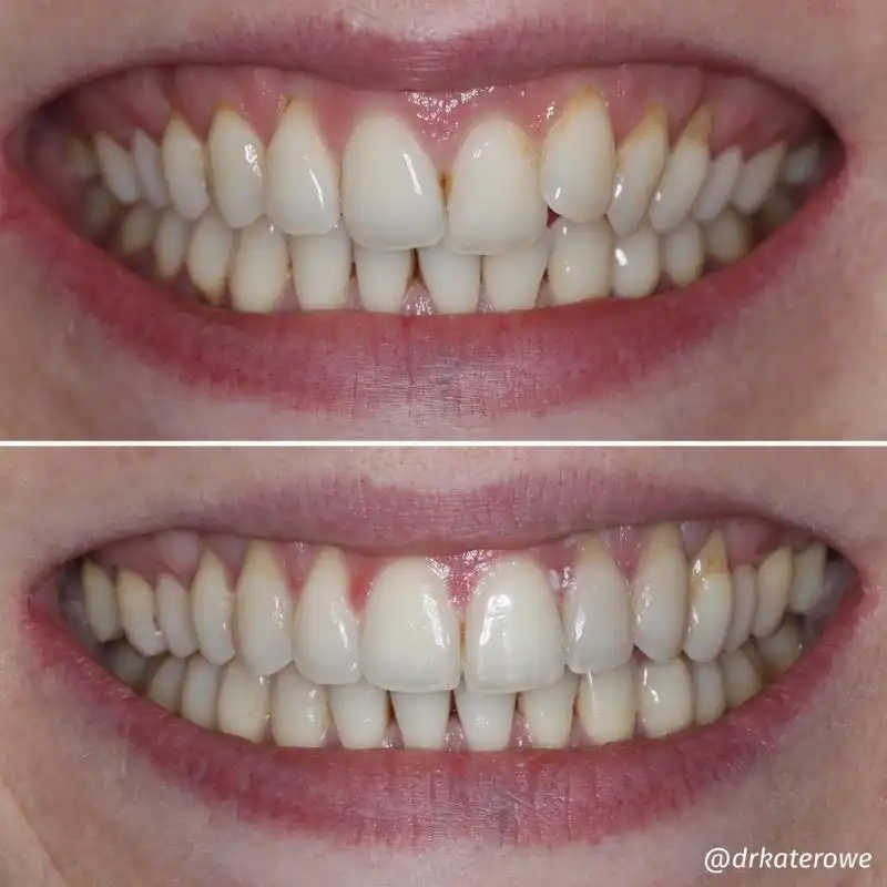 Hanham Dental Smile Gallery