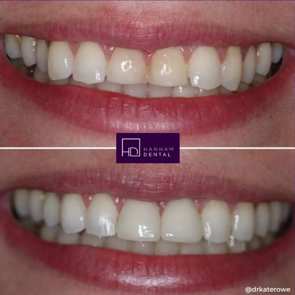 Hanham Dental Smile Gallery