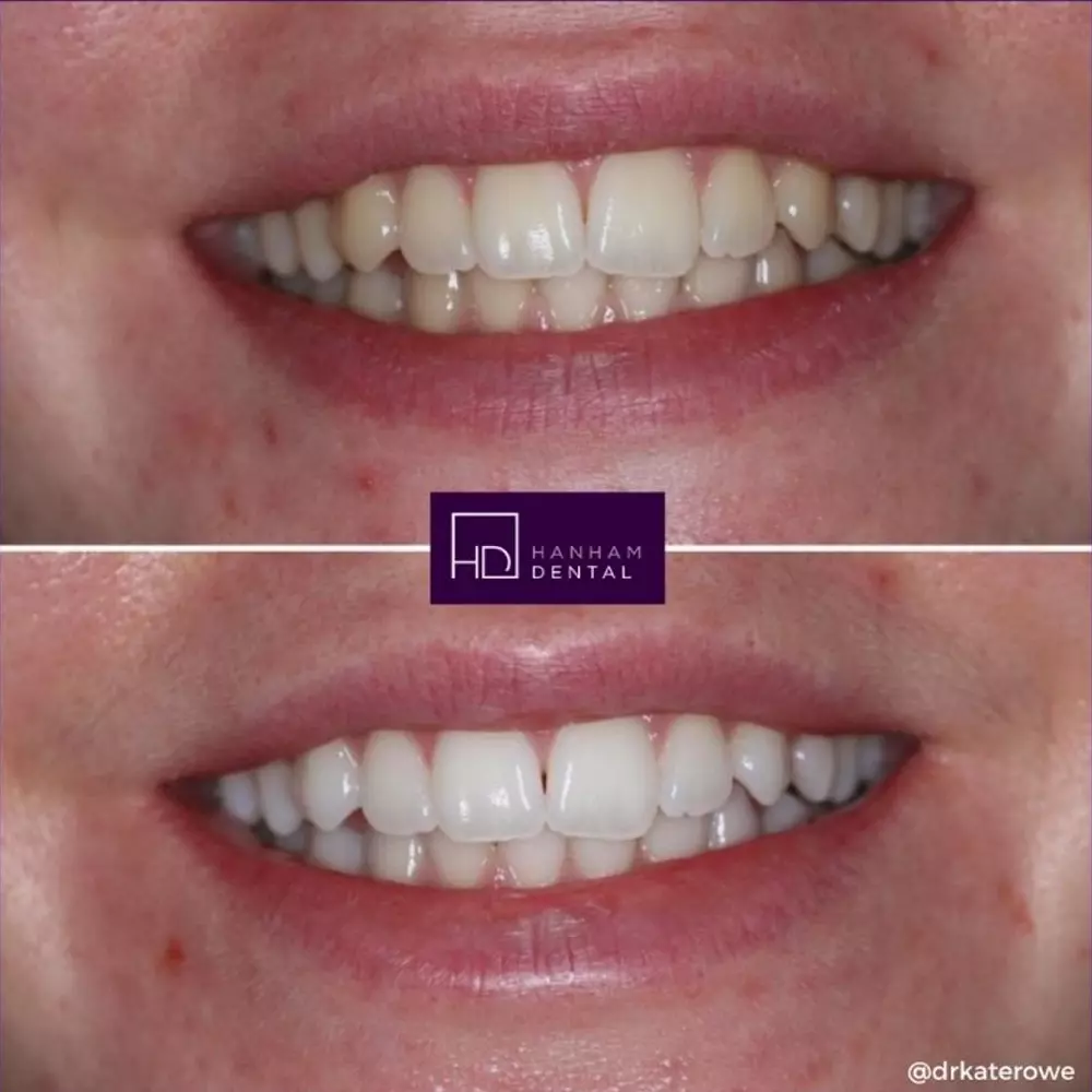 Hanham Dental Smile Gallery